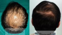 FUE Hair Transplant for Crown