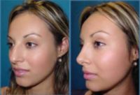 Woman treated with Rhinoplasty