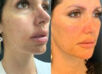 woman treated with Dermal Fillers