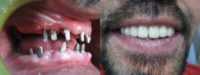 Full mouth dental Implants with porcelin fused to metal dental bridge.