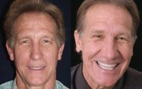 Full Mouth Reconstruction on 54 Year Old Male