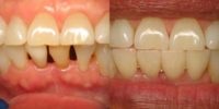 Gaps between the bottom teeth
