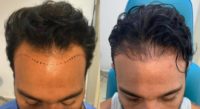 Hair Transplant