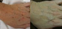 IPL to hands After 2 treatments