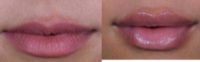 Injectable Fillers for the Lips