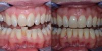 Invisalign to Correct Crowding and Deep Bite