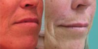 Juvederm to the upper lip