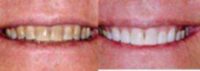 Kor Deep Bleaching Tooth Whitening System
