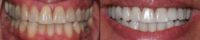 Woman treated with Porcelain Veneers