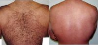 Laser Hair Removal Male 28 year old