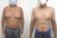 Man treated with Gynecomastia Surgery