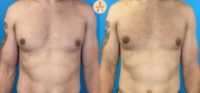 Man treated with Gynecomastia Surgery