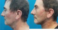 Man treated with Facelift