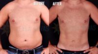 Man treated with Vaser Liposuction