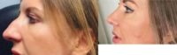 Woman treated with Rhinoplasty