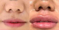 Woman treated with Lip Fillers