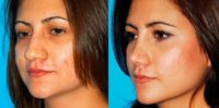 Woman treated with Rhinoplasty