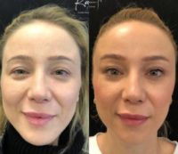 Woman treated with Brow Lift