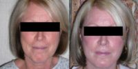 Woman treated with Facelift