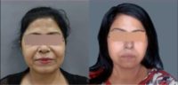 Woman treated with Chemical Peel