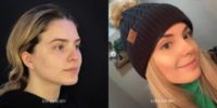 Woman treated with Rhinoplasty