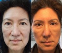 Woman treated with Facelift