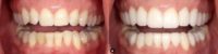 Woman treated with Porcelain Veneers, Dental Crown, Smile Makeover