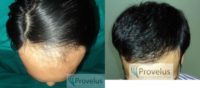 N/W 4A, Indian, 3400 graft FUE