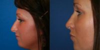 Rhinoplasty