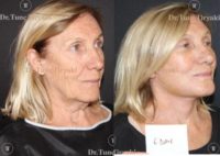 Patient treated with Facelift
