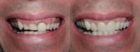 Porcelain Veneers, Crowns, Teeth Whitening, and Gummy Smile Repair