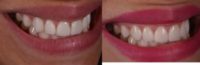 Revision Case of 25-34 year old woman treated with Porcelain Veneers