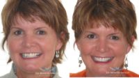Six Month Smile/ Short term orthodontics