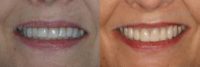 Smile Makeover with Porcelain Veneers