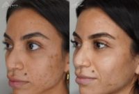 Woman treated with Microneedling