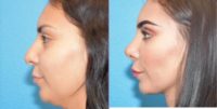 Woman treated with Rhinoplasty