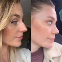 Woman treated with Rhinoplasty