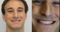 Teeth gap treated with Invisalign