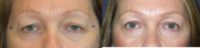 Upper eyelid skin reduction (blepharoplasty)