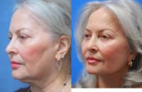 Woman in her 70s treated with Facelift